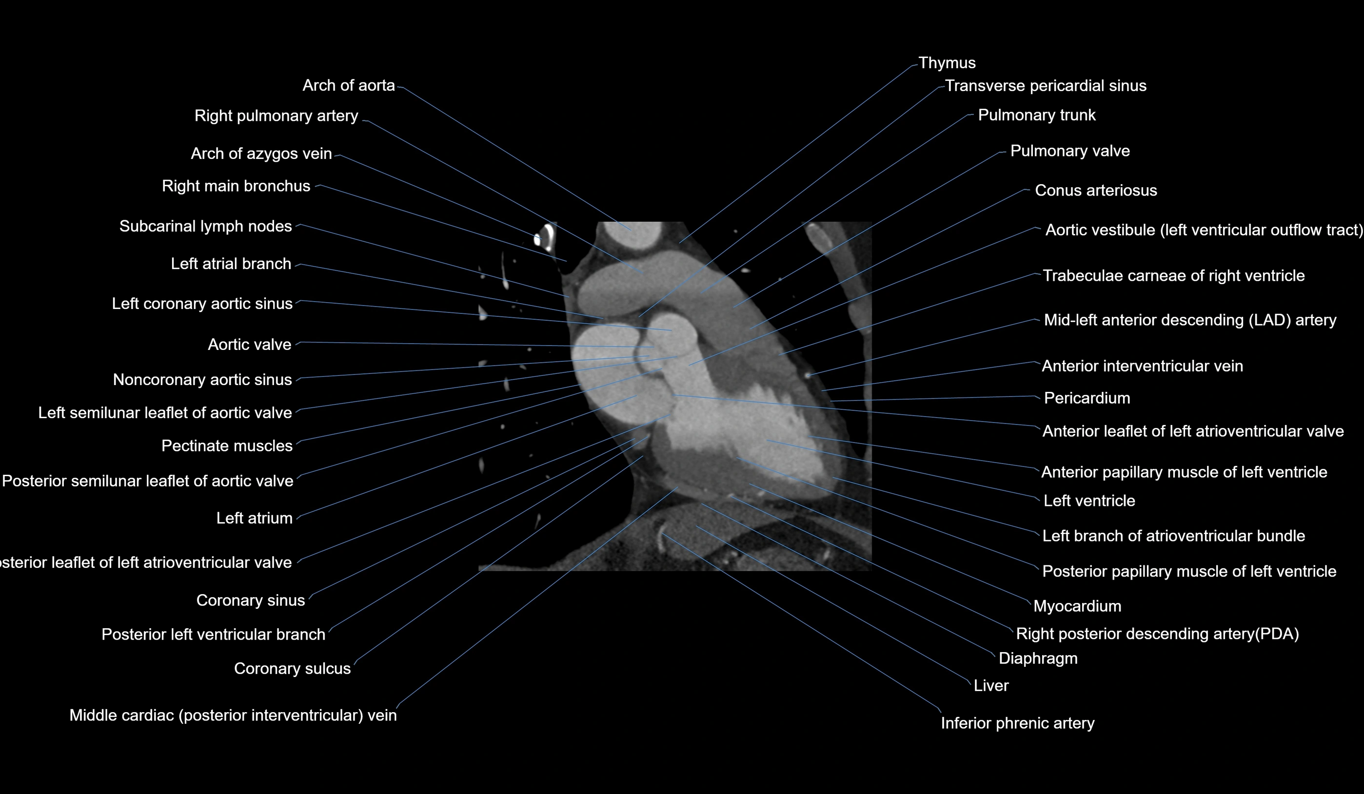 CT heart (coronary angiogram) 2 chamber view cross sectional anatomy labelled radiology image-00020.webp